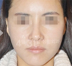 April 31 Plastic Surgery,Reviews,Images,Promotions — Korea cost, reviews & before-after | MISOODA