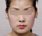 Theline Plastic Surgery,Reviews,Images, Promotions — Korea cost, reviews & before-after | MISOODA