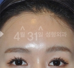 April 31 Plastic Surgery,Reviews,Images,Promotions — Korea cost, reviews & before-after | MISOODA