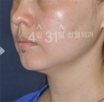 April 31 Plastic Surgery,Reviews,Images,Promotions — Korea cost, reviews & before-after | MISOODA