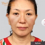 Theline Plastic Surgery,Reviews,Images, Promotions — Korea cost, reviews & before-after | MISOODA