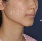 April 31 Plastic Surgery,Reviews,Images,Promotions — Korea cost, reviews & before-after | MISOODA