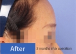 face lift
