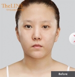 Theline Plastic Surgery,Reviews,Images, Promotions — Korea cost, reviews & before-after | MISOODA