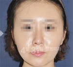 April 31 Plastic Surgery,Reviews,Images,Promotions — Korea cost, reviews & before-after | MISOODA