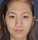April 31 Plastic Surgery,Reviews,Images,Promotions — Korea cost, reviews & before-after | MISOODA