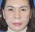 April 31 Plastic Surgery,Reviews,Images,Promotions — Korea cost, reviews & before-after | MISOODA