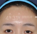 April 31 Plastic Surgery,Reviews,Images,Promotions — Korea cost, reviews & before-after | MISOODA