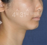 April 31 Plastic Surgery,Reviews,Images,Promotions — Korea cost, reviews & before-after | MISOODA