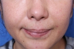 Deesse Plastic Surgery, Reviews,Images, Promotions — Korea cost, reviews & before-after | MISOODA
