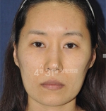 April 31 Plastic Surgery,Reviews,Images,Promotions — Korea cost, reviews & before-after | MISOODA