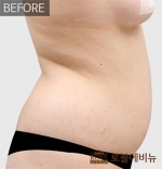 Rovl Avenue Liposuction,Reviews,Images, Promotions — Korea cost, reviews & before-after | MISOODA