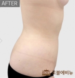 Rovl Avenue Liposuction,Reviews,Images, Promotions — Korea cost, reviews & before-after | MISOODA