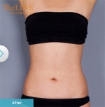 Theline Plastic Surgery,Reviews,Images, Promotions — Korea cost, reviews & before-after | MISOODA