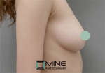 Mine Plastic Surgery, Reviews, Images, Promotions — Korea cost, reviews & before-after | MISOODA
