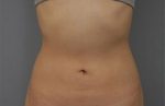 Rovl Avenue Liposuction,Reviews,Images, Promotions — Korea cost, reviews & before-after | MISOODA