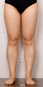 Theline Plastic Surgery,Reviews,Images, Promotions — Korea cost, reviews & before-after | MISOODA