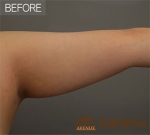 Rovl Avenue Liposuction,Reviews,Images, Promotions — Korea cost, reviews & before-after | MISOODA