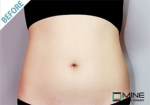 Mine Plastic Surgery, Reviews, Images, Promotions — Korea cost, reviews & before-after | MISOODA