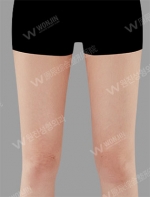 liposuction