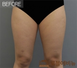 Rovl Avenue Liposuction,Reviews,Images, Promotions — Korea cost, reviews & before-after | MISOODA