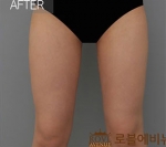 Rovl Avenue Liposuction,Reviews,Images, Promotions — Korea cost, reviews & before-after | MISOODA