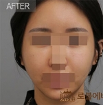 Rovl Avenue Liposuction,Reviews,Images, Promotions — Korea cost, reviews & before-after | MISOODA