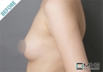 Mine Plastic Surgery, Reviews, Images, Promotions — Korea cost, reviews & before-after | MISOODA