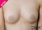 Mine Plastic Surgery, Reviews, Images, Promotions — Korea cost, reviews & before-after | MISOODA