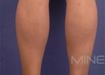 Mine Plastic Surgery, Reviews, Images, Promotions — Korea cost, reviews & before-after | MISOODA
