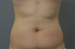 Rovl Avenue Liposuction,Reviews,Images, Promotions — Korea cost, reviews & before-after | MISOODA