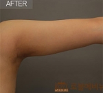 Rovl Avenue Liposuction,Reviews,Images, Promotions — Korea cost, reviews & before-after | MISOODA