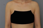 Rovl Avenue Liposuction,Reviews,Images, Promotions — Korea cost, reviews & before-after | MISOODA