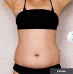 Theline Plastic Surgery,Reviews,Images, Promotions — Korea cost, reviews & before-after | MISOODA