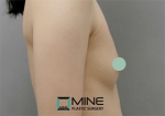Mine Plastic Surgery, Reviews, Images, Promotions — Korea cost, reviews & before-after | MISOODA