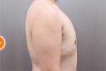 liposuction