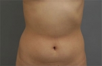 Rovl Avenue Liposuction,Reviews,Images, Promotions — Korea cost, reviews & before-after | MISOODA