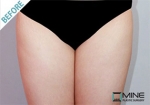 Mine Plastic Surgery, Reviews, Images, Promotions — Korea cost, reviews & before-after | MISOODA