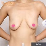 Theline Plastic Surgery,Reviews,Images, Promotions — Korea cost, reviews & before-after | MISOODA