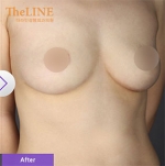 Theline Plastic Surgery,Reviews,Images, Promotions — Korea cost, reviews & before-after | MISOODA