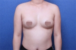 Deesse Plastic Surgery, Reviews,Images, Promotions — Korea cost, reviews & before-after | MISOODA