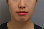 Rovl Avenue Liposuction,Reviews,Images, Promotions — Korea cost, reviews & before-after | MISOODA