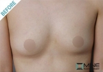 Mine Plastic Surgery, Reviews, Images, Promotions — Korea cost, reviews & before-after | MISOODA