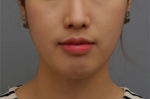 Rovl Avenue Liposuction,Reviews,Images, Promotions — Korea cost, reviews & before-after | MISOODA