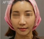 Rovl Avenue Liposuction,Reviews,Images, Promotions — Korea cost, reviews & before-after | MISOODA