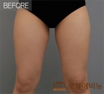 Rovl Avenue Liposuction,Reviews,Images, Promotions — Korea cost, reviews & before-after | MISOODA
