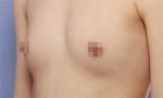 breast