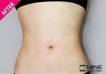 Mine Plastic Surgery, Reviews, Images, Promotions — Korea cost, reviews & before-after | MISOODA