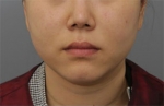 Rovl Avenue Liposuction,Reviews,Images, Promotions — Korea cost, reviews & before-after | MISOODA