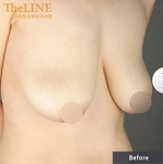Theline Plastic Surgery,Reviews,Images, Promotions — Korea cost, reviews & before-after | MISOODA